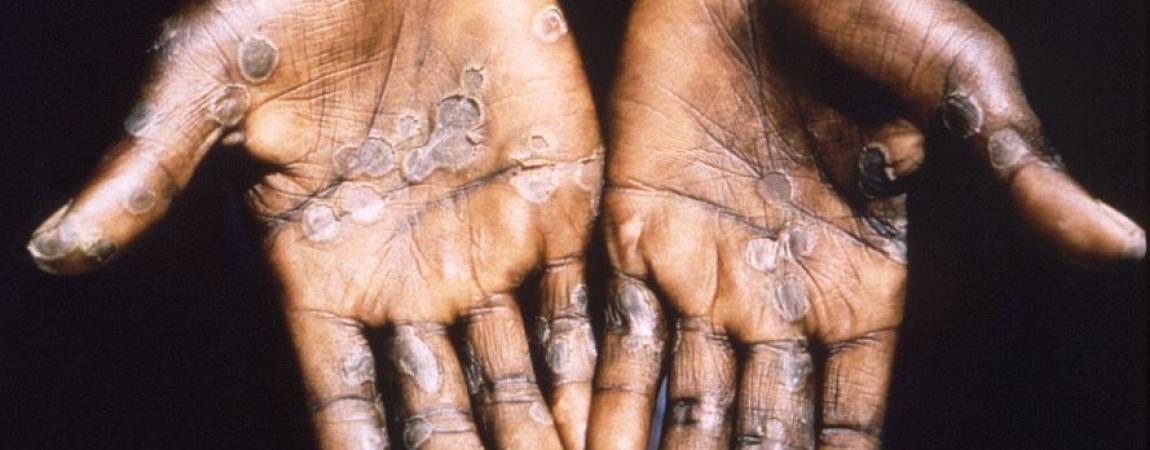 Monkeypox Patient Hands