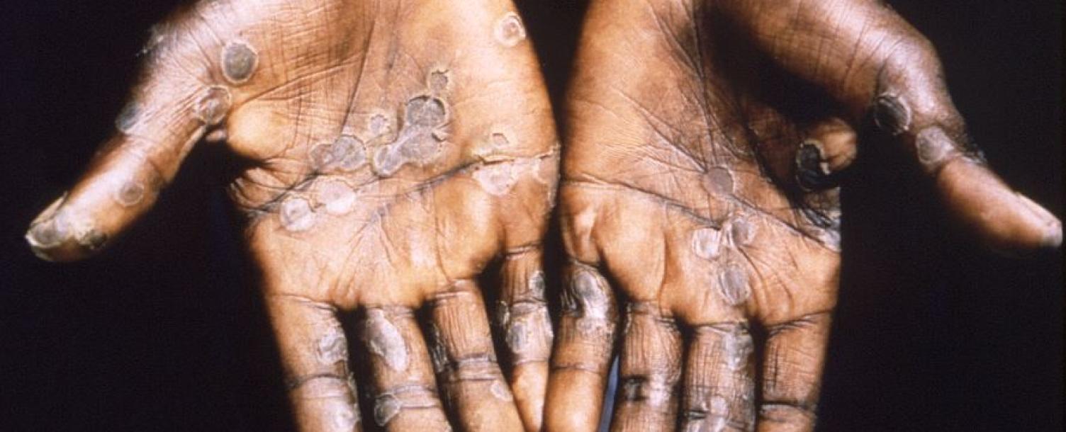 Monkeypox Patient Hands